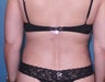 Liposuction