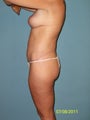 Bodylift 