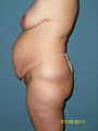 Bodylift 