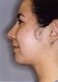 Liposuction Face and Neck
