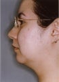 Liposuction Face and Neck