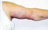 Female patient who underwent an arm lift 