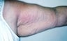 Female patient who underwent an arm lift 