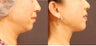 Neck Lift