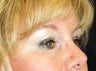Eyelid Surgery
