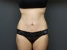 Mini abdominoplasty with liposuction
