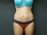 Mini abdominoplasty with liposuction