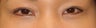Asian Eyelid Surgery