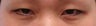 Asian Eyelid Surgery
