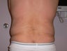 47 year old man has Liposuction Surgery