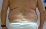 47 year old man has Liposuction Surgery