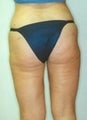 Female patient who underwent a butt lift