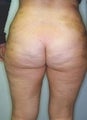 Female patient who underwent a butt lift