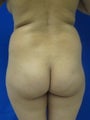 Brazilian Buttlift