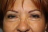 Eyelid Surgery