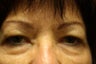 Eyelid Surgery