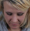 Rhinoplasty