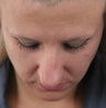 Rhinoplasty