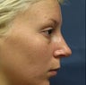 Rhinoplasty