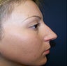 Rhinoplasty