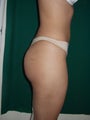 brazilian butt lift