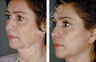 Complete Facial Rejuvenation