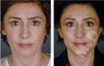 Complete Facial Rejuvenation