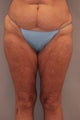 Thigh Lift