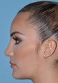 Rhinoplasty