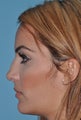 Rhinoplasty