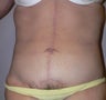 58 year old woman has Belt Lipectomy