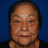 Brow Lift