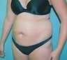 45 year old female patient 