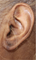 Ear Lobe Surgery
