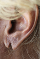 Ear Lobe Surgery
