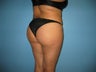 Brazilian buttock lift (fat transfer to buttock)
