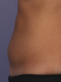 CoolSculpting by Zeltiq to abdomen