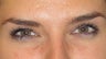 Botox