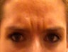 Botox