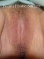 Labial Reduction