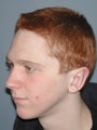 Otoplasty/Ear Surgery