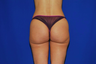 Liposuction