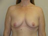 39 year old female with 475 cc saline implants