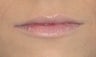 Lip Augmentation