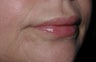 Lip Augmentation