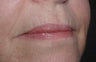 Lip Augmentation