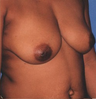Inverted nipples