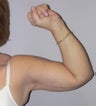 58 year old woman has Arm Lift