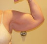 58 year old woman has Arm Lift
