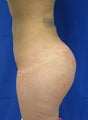 Butt augmentation